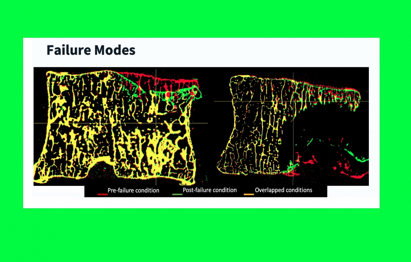 64 - “Stratification of patients with spine metastases at high risk of fracture: from biomechanical analyses in the laboratory to an in silico clinical tool”